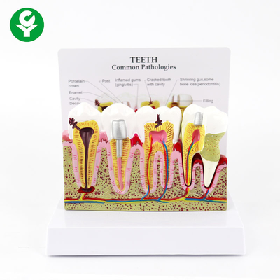 Periodontalne zęby zębowe Model Ludzkie próchnicy Wyświetlanie wspólnych patologii